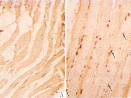 肌營養(yǎng)不良癥受累肌肉的細胞凋亡