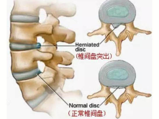 無菌性炎癥致痛學(xué)說與頸肩腰腿痛的發(fā)病機制